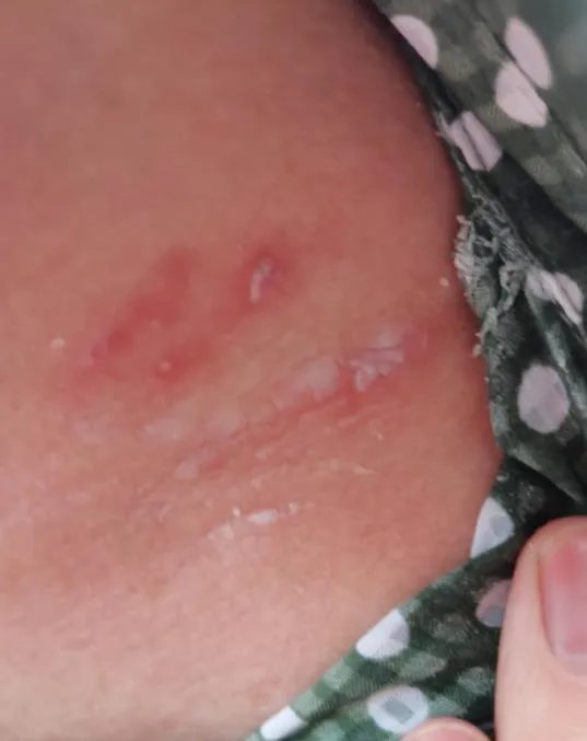 隐翅虫咬人后图片，网友实拍五花八门隐翅虫咬伤后画面