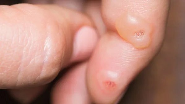 烫伤起泡该怎么办