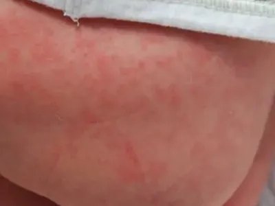 新生儿红斑狼疮红斑图片