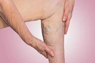 静脉曲张怎么治疗 治疗静脉曲张我有四个妙招