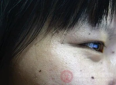 去除眼部皱纹的方法