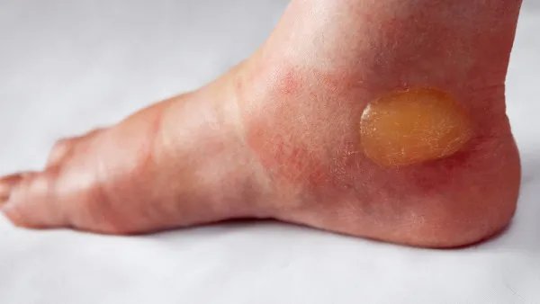 烫伤起泡该怎么办