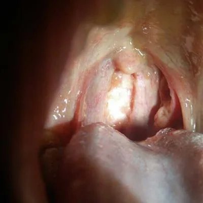 咳痰是怎么引起的?