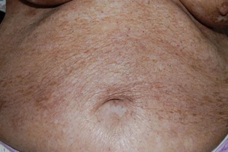 干性湿疹斑图片