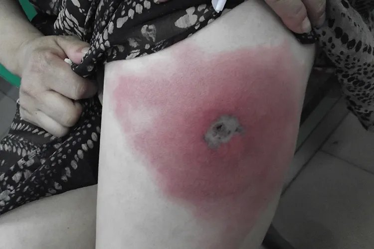 各种虫咬性皮炎过敏图片