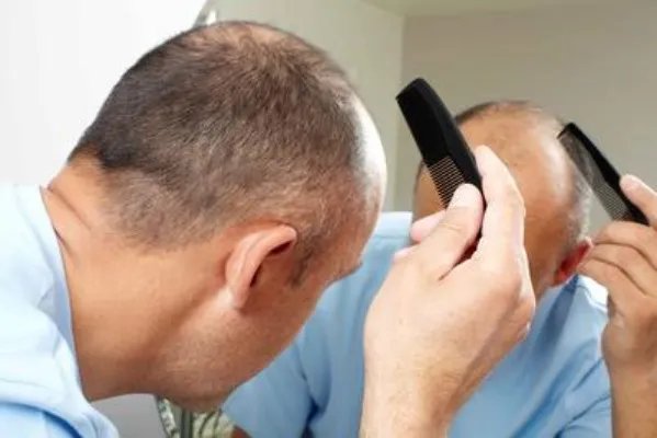 为什么湿热体质会脱发 湿热体质脱发如何调理好