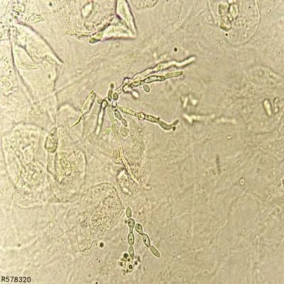 白带豆腐渣状是怎么回事呀