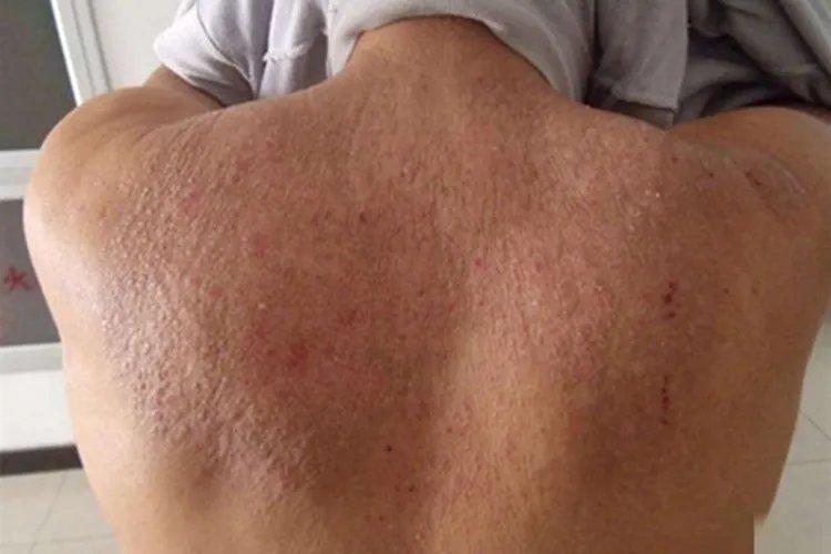 皮肤淀粉样变症状图片