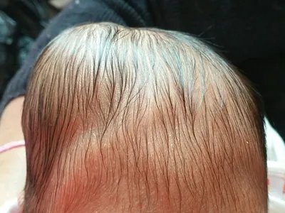 韩-薛-柯病头皮变形图片