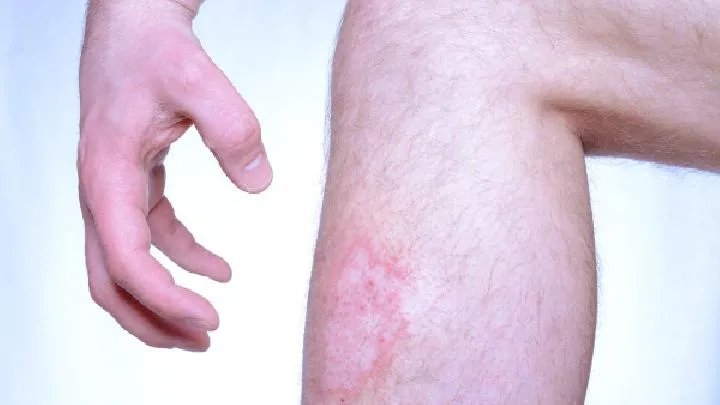 手癣应该怎么检查