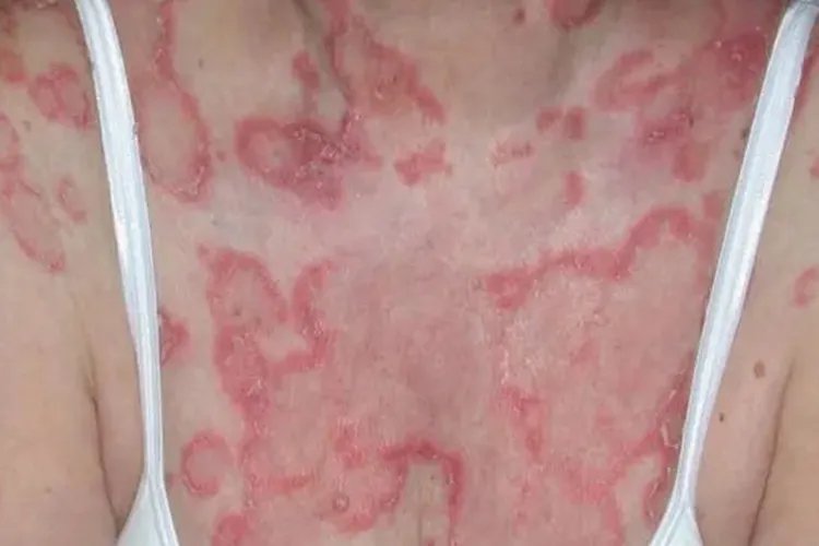 自身免疫性皮炎图片