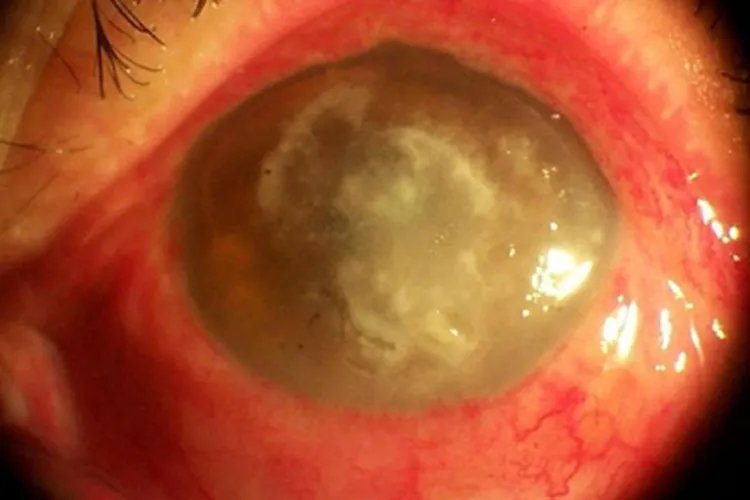 真菌性角膜炎眼部症状图片
