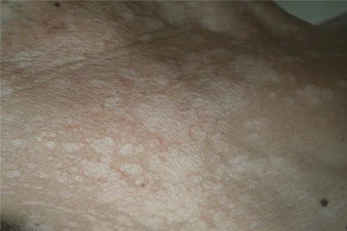 花斑癣汗斑图片