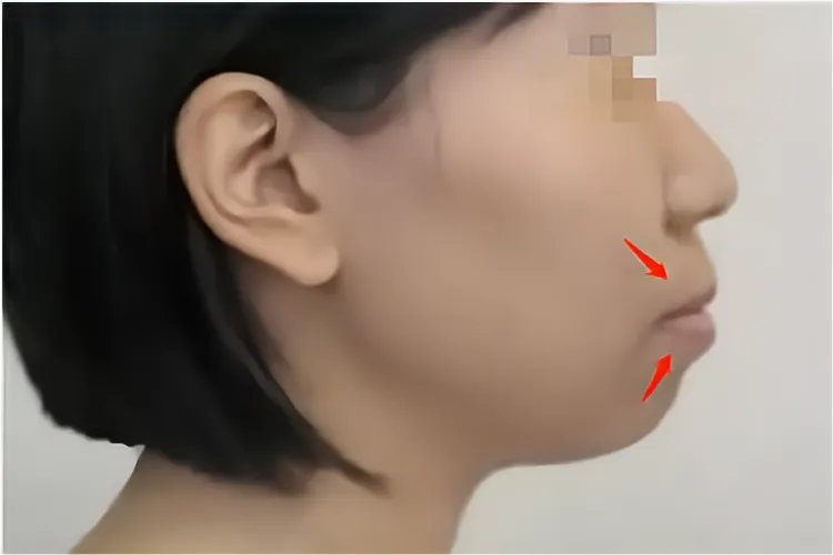 儿童严重大龅牙图片