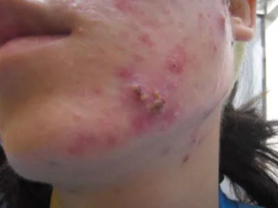 青春痘如何食疗