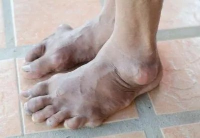 吃什么能消除痛风石