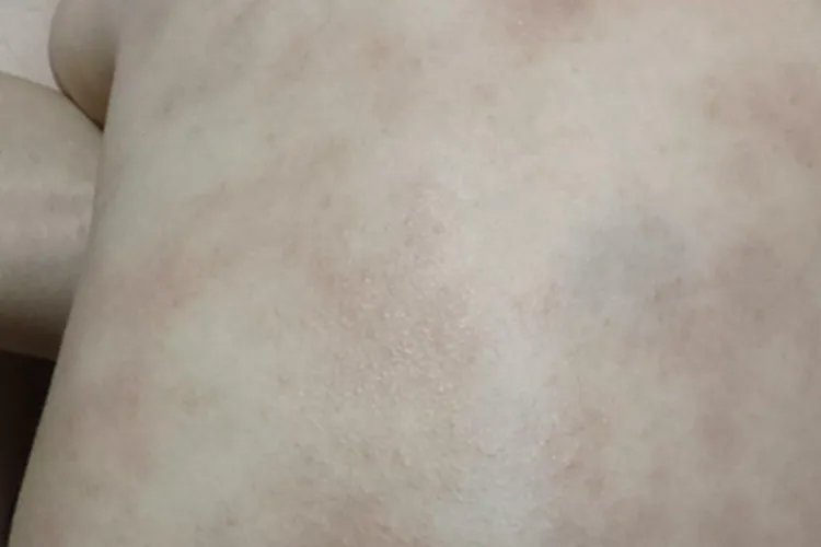 干性湿疹斑图片