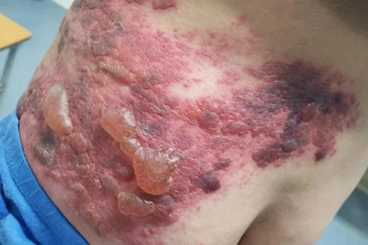 带状疱疹疙瘩图片