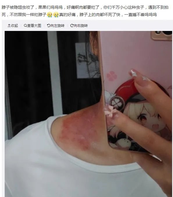 隐翅虫咬人后图片，网友实拍五花八门隐翅虫咬伤后画面