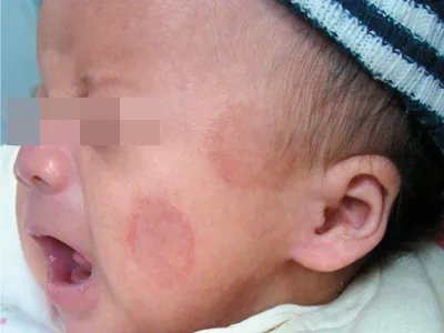 新生儿红斑狼疮红斑图片