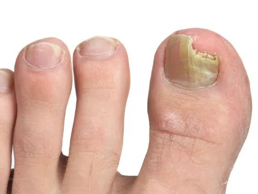 脚趾甲变厚怎么治疗