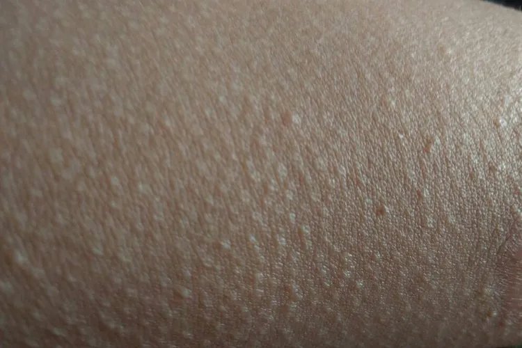 毛周角化症图片