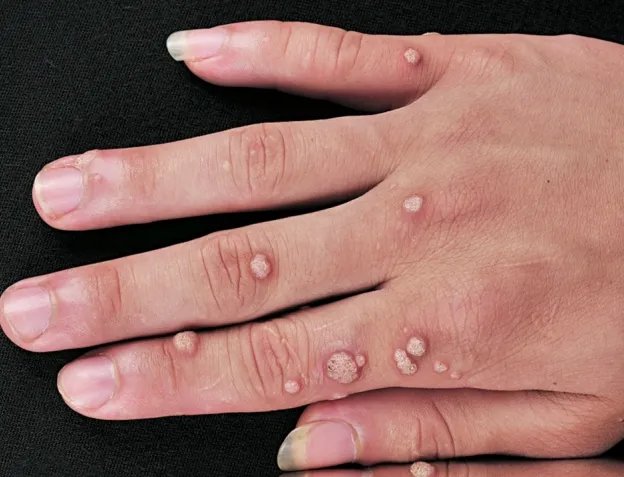 身体上长瘊子图片