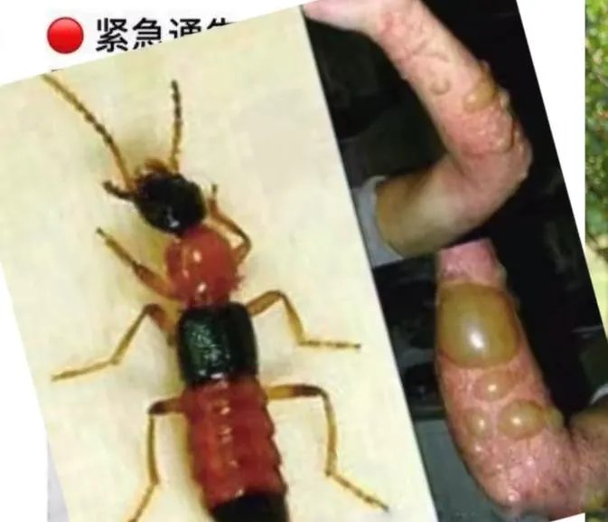 隐翅虫咬人后图片，网友实拍五花八门隐翅虫咬伤后画面