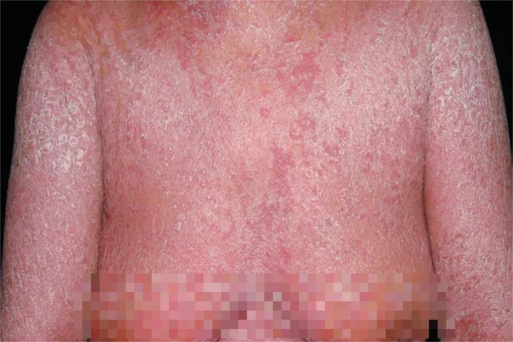 银屑病的症状表现图片