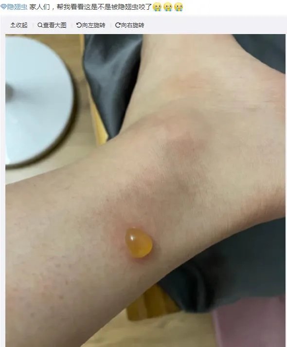 隐翅虫咬人后图片，网友实拍五花八门隐翅虫咬伤后画面