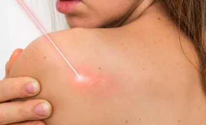 胎记可以激光去掉吗