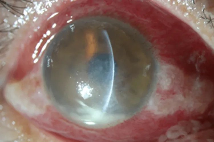 真菌性角膜炎眼部症状图片