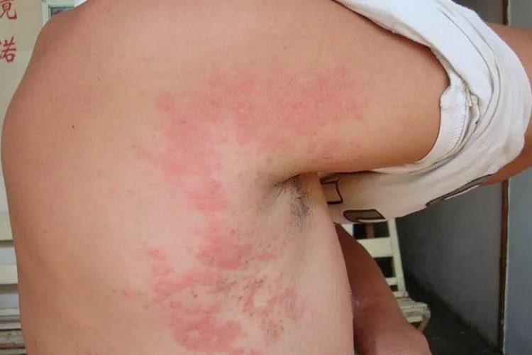 各种虫咬性皮炎过敏图片