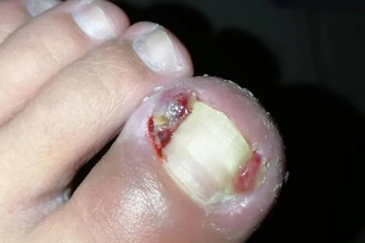 甲沟炎化脓图片