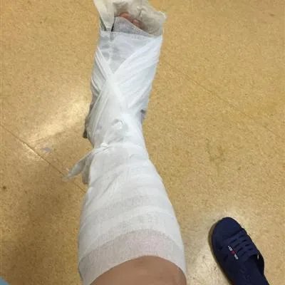 弹响髋是怎么回事?