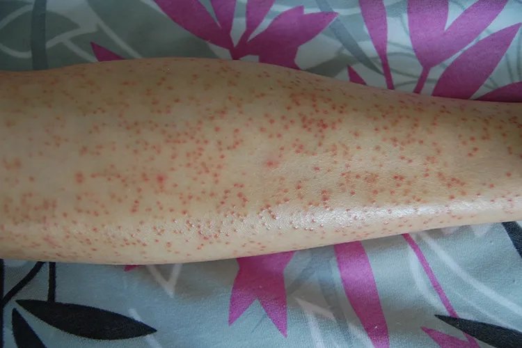 红疹初期症状图片