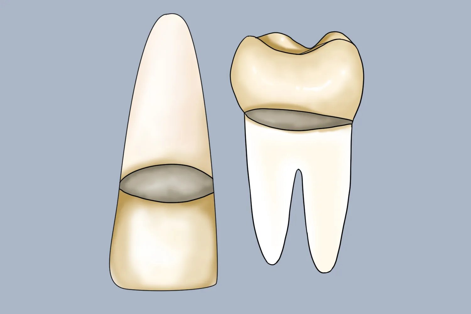 牙齿洞型分类及图片