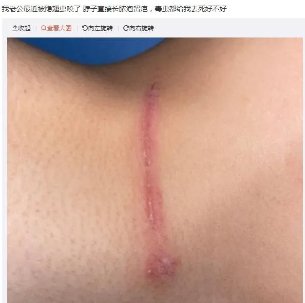 隐翅虫咬人后图片，网友实拍五花八门隐翅虫咬伤后画面