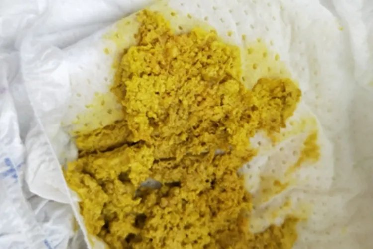 新生儿便便图片分析