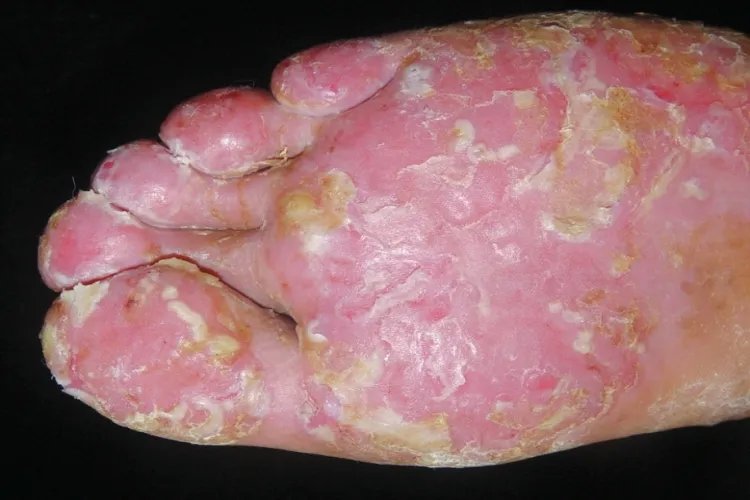 银屑病的症状表现图片