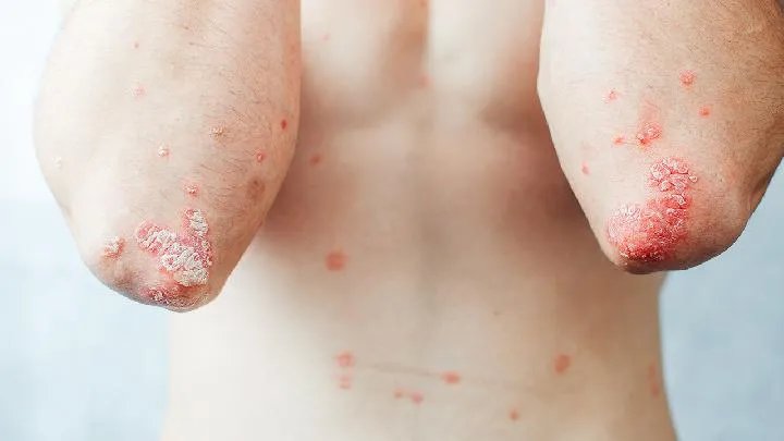 手癣应该怎么检查