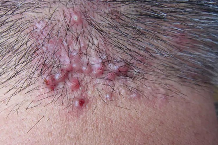 毛周角化症图片