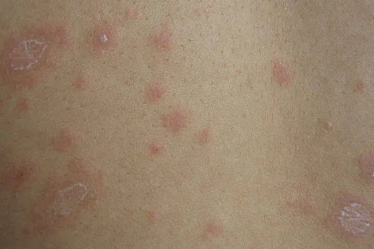 红疹初期症状图片