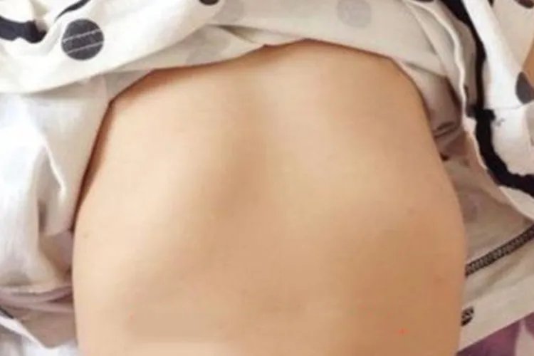 轻度小孩鸡胸图片