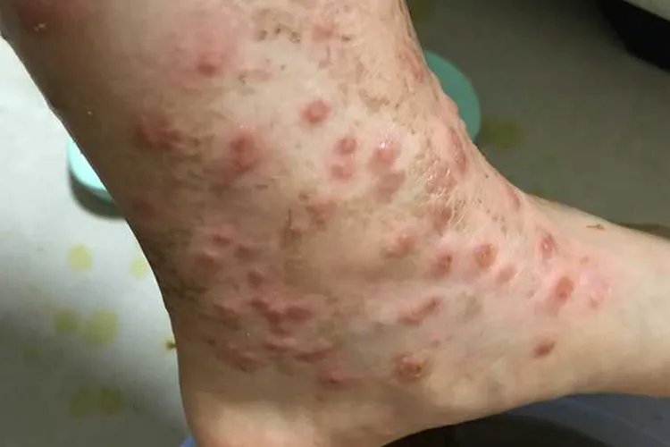 各种虫咬性皮炎过敏图片