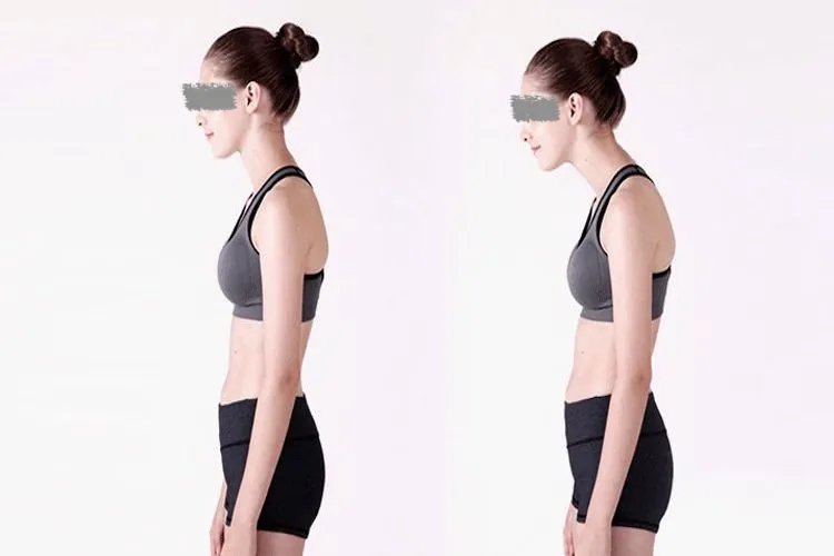 头前倾驼背图片