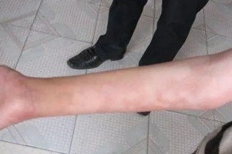 麻风病最初样子图片