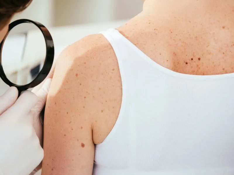 疥疮最好的治疗方法