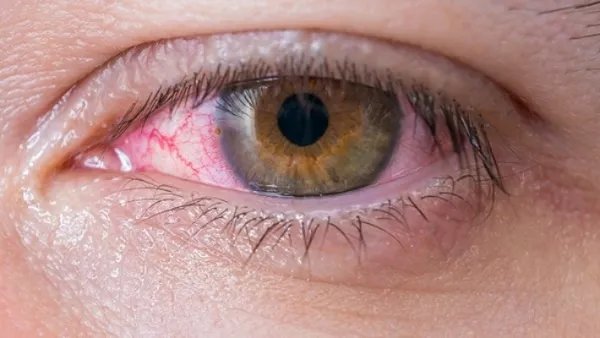 孕妇得了红眼病要怎么办 孕妇得了红眼病该如何进行治疗