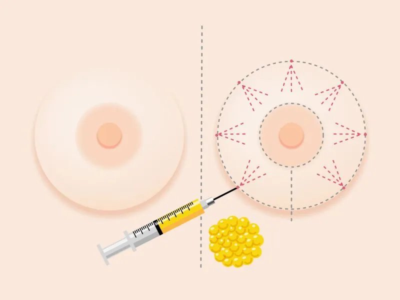 男性乳头发黑是怎么回事